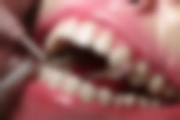 广州卢林凤口腔门诊拔牙多少钱？现在预约仅需600元起，原价800元起，抓住机会，体验杰出服务！