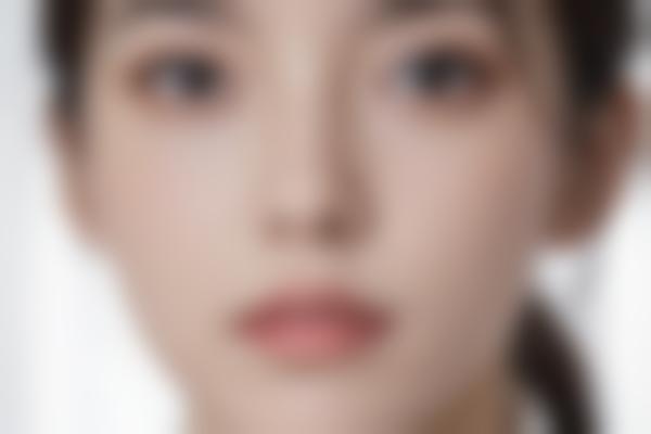 4、静萍胎记疤痕修复可靠