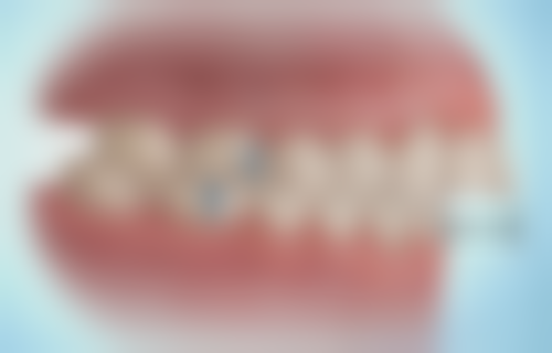 二、30岁选择种植牙的优势