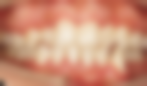 十、总结：30岁种植牙更优，但因人而异