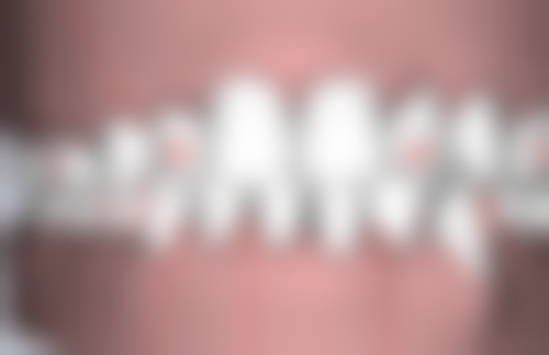 六、哪些人更适合假牙？