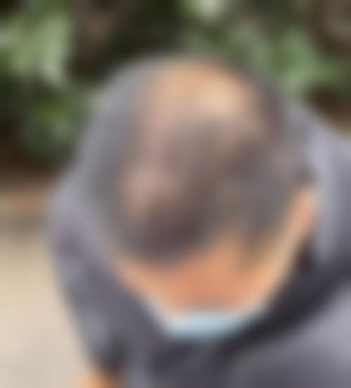 杭州百年植发医生团队经验稳定。