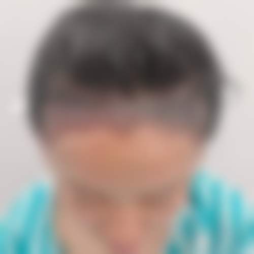 杭州百年植发