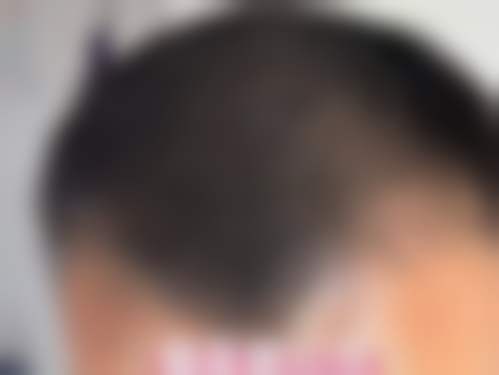 杭州百年植发治疗反馈与口碑评价。
