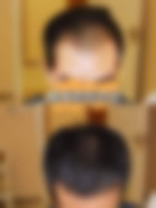杭州百年植发
