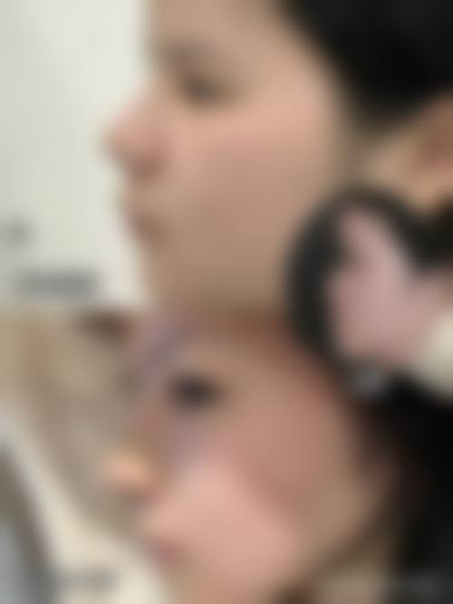 石家庄蓝山医疗美容医院植发中 心治疗反馈与口碑评价。